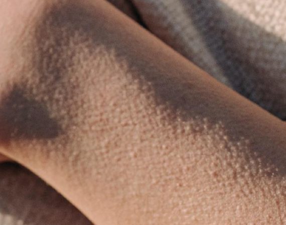 De kou en mijn huid.