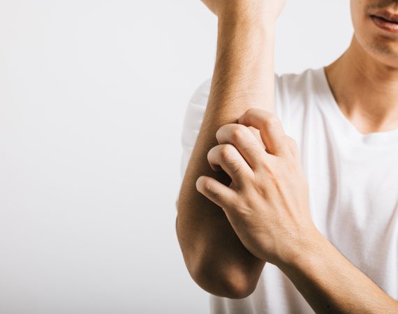 Eczeem en de gevoelige huid: wat kun je zelf doen?